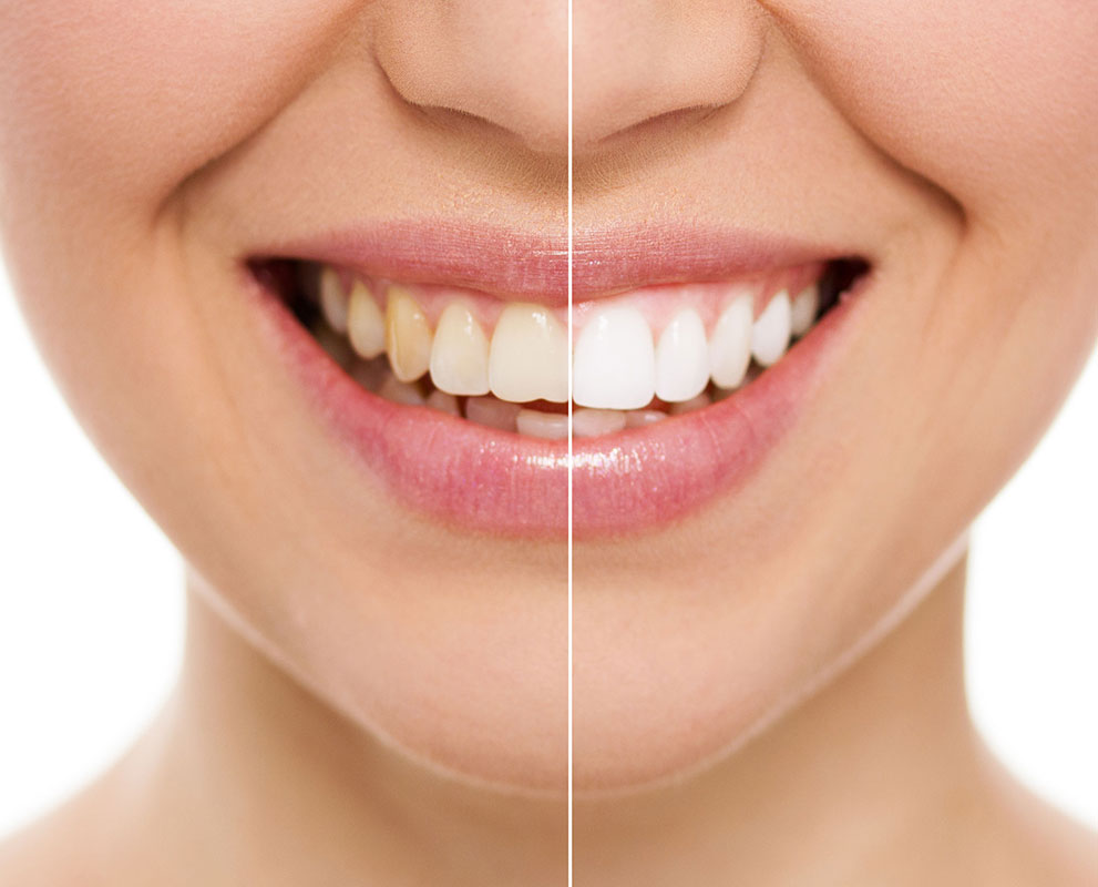 Dental Whitening Treatments in Malaysia: Brightening Smiles with Modern Solutions