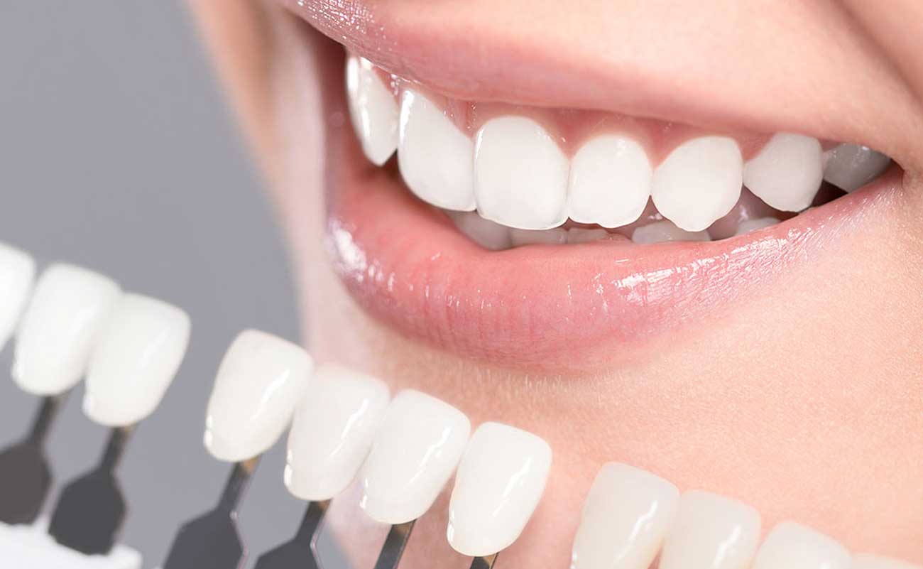 Teeth Whitening in Malaysia: Achieving a Brighter Smile